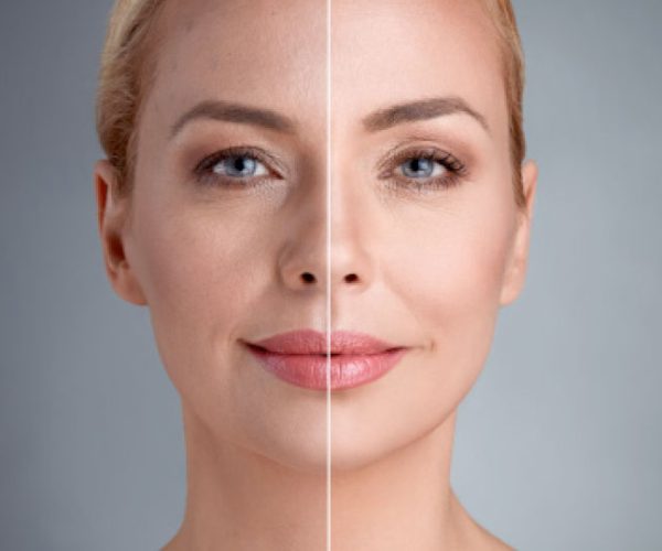 Anti-aging cilt bakımı öncesi ve sonrası görünüm
